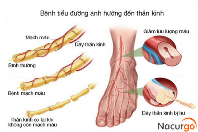 bien-chung-than-kinh-ngoai-vi