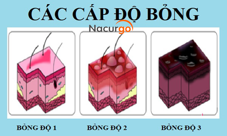 Các cấp độ bỏng