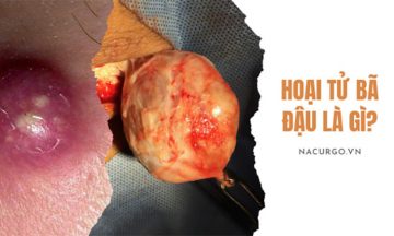 Hoại tử bã đậu là gì