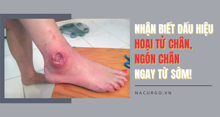 Nhận biết hoại tử chân, ngón chân