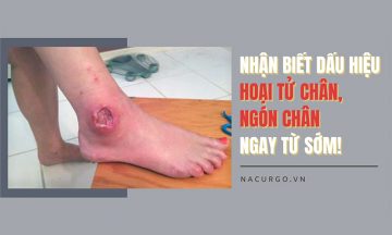 Nhận biết hoại tử chân, ngón chân