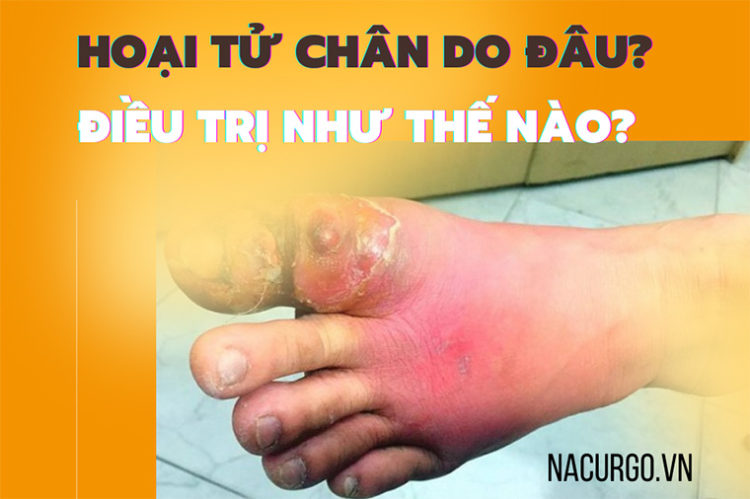 Hoại tử chân, ngón chân điều trị như thế nào