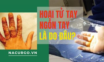Hoại tử tay, ngón tay là do đây?