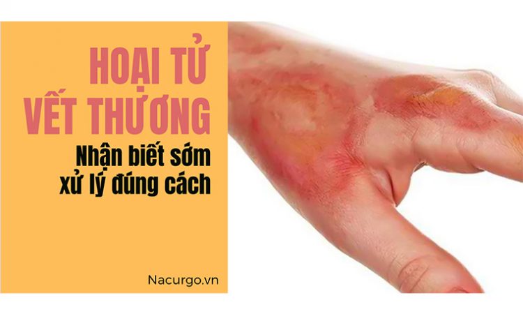 Vết thương hoại tử nhận biết từ sớm để chăm sóc và điều trị đúng cách! Vết thương hoại tử nhận biết từ sớm để chăm sóc và điều trị đúng cách!