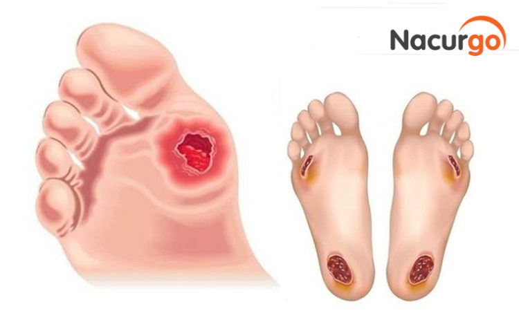 Nhận biết hoại tử vết thương và xử lý đúng cách