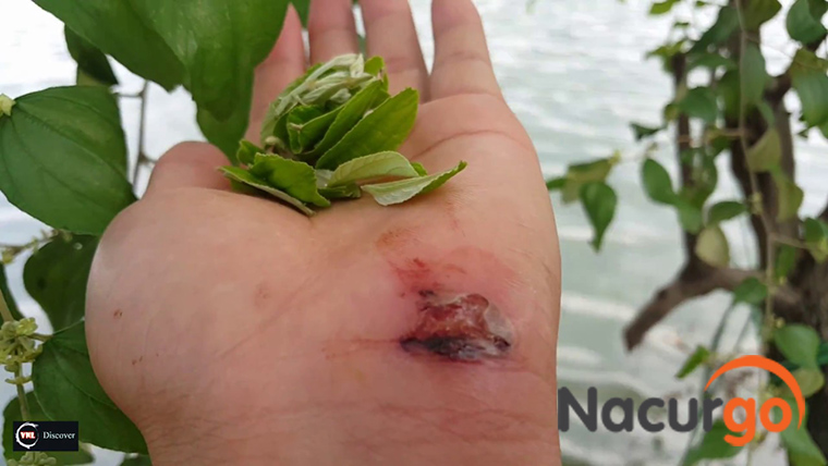 Nhận biết hoại tử vết thương và xử lý đúng cách