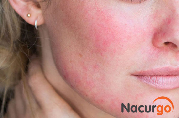 nấm, vi khuẩn ký sinh trùng lâu ngày trên da mặt gây tổn thương da