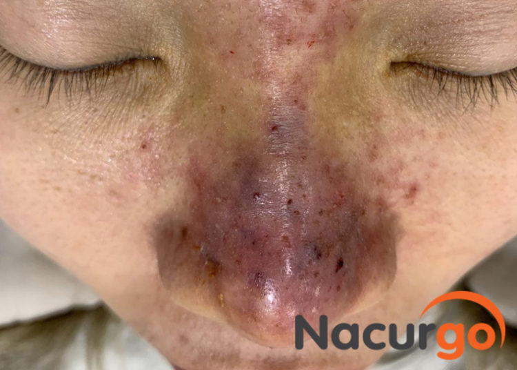 Tiêm filler không rõ nguồn gốc