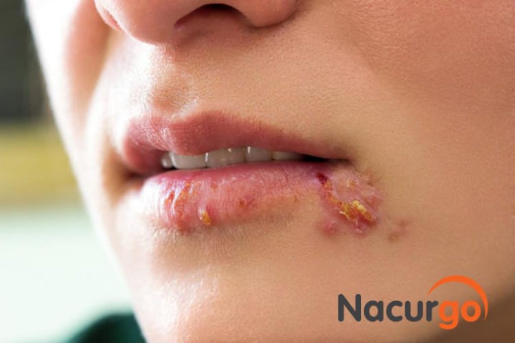 Bệnh hình thành do các vết lở lớt trên da không được xử lý