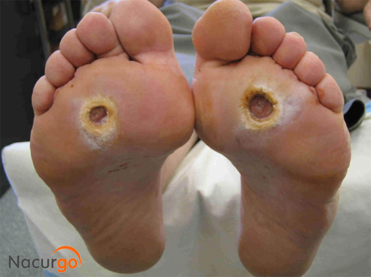 vi-sao-nguoi-tieu-duong-bi-lo-loet