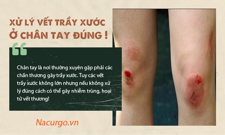 Xử lý đúng cách vết trầu xước để tránh nhiễm trùng, hoại tử