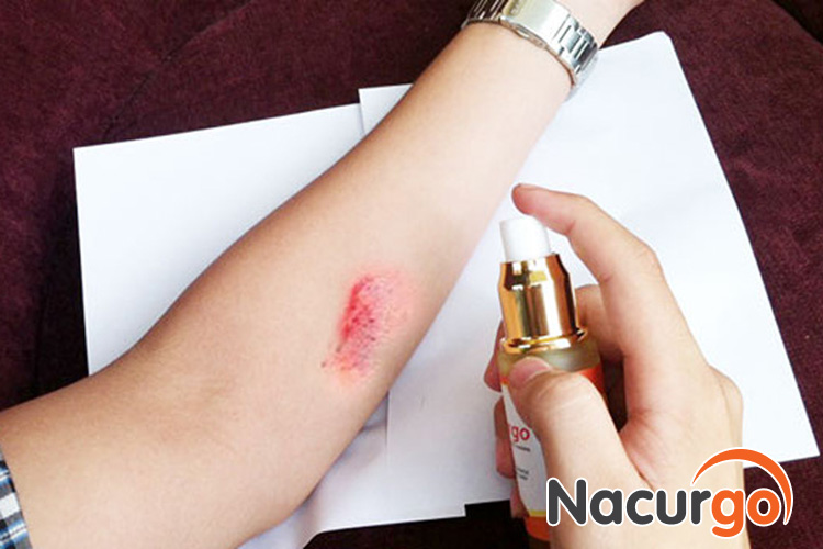 Băng vết thương bằng màng sinh học Nacurgo