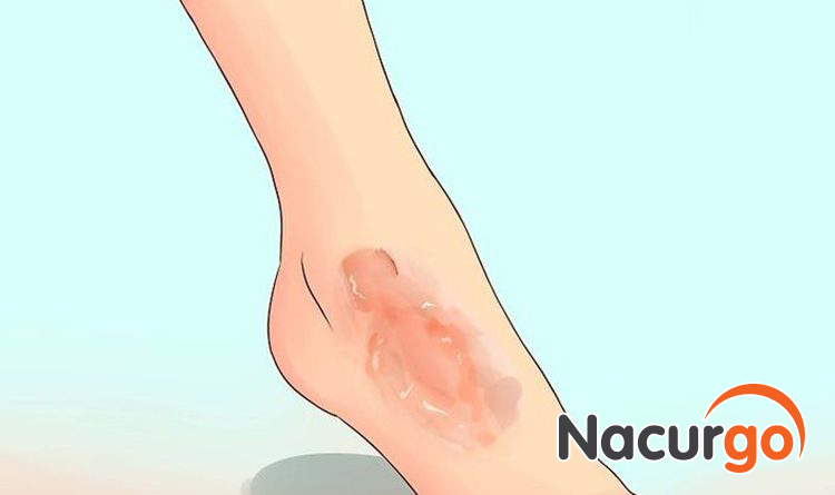 Betadine sát khuẩn vết thương hở