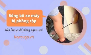 bong-bo-xe-may-bi-phong