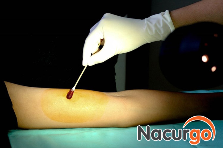 Povidine 10% sát trùng trước và sau khi tiểu phẫu