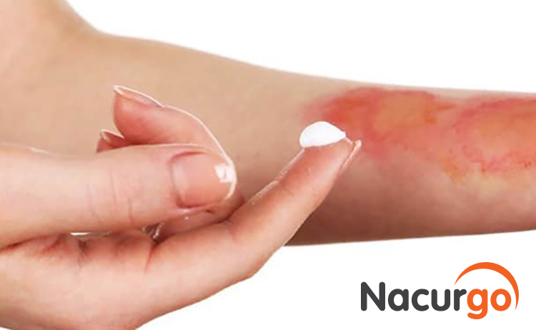 Nên bôi kem đánh răng vào vết bỏng?
