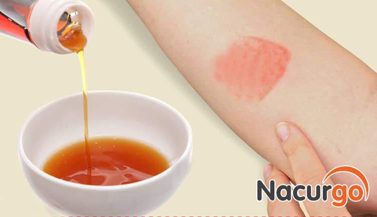 Không sử dụng nước mắm chữa bỏng