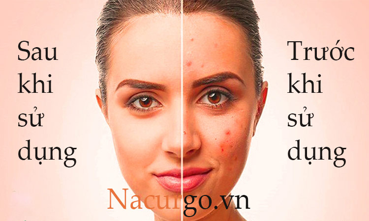 Nacurgo dạng xịt trị mụn có hiệu quả không?