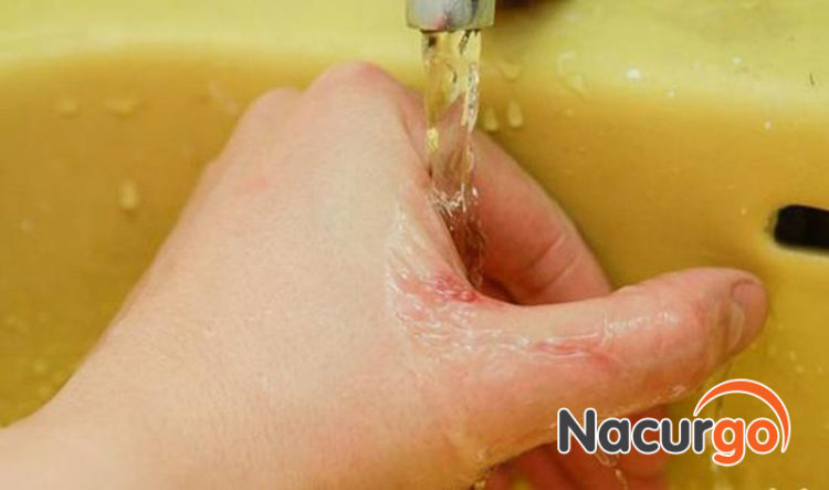 Rửa sạch vết thương