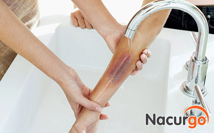 bị bỏng có nên bôi kem đánh răng không?