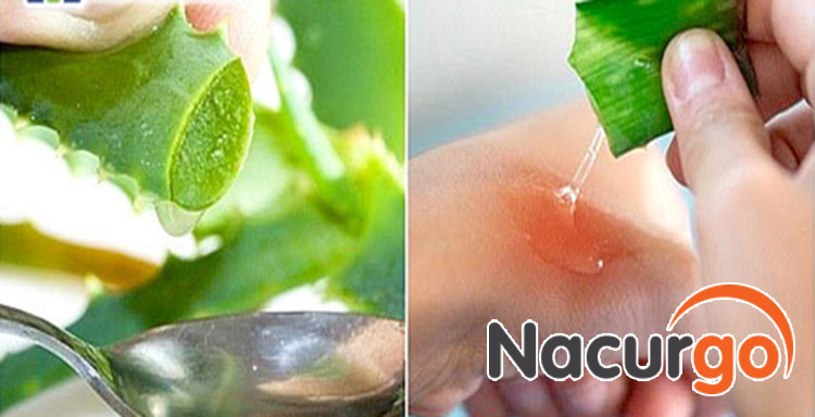 Thực hư chữa bỏng bằng nha đam