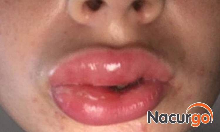 Bị bỏng môi do làm đẹp ở các thẩm mỹ viện không đảm bảo