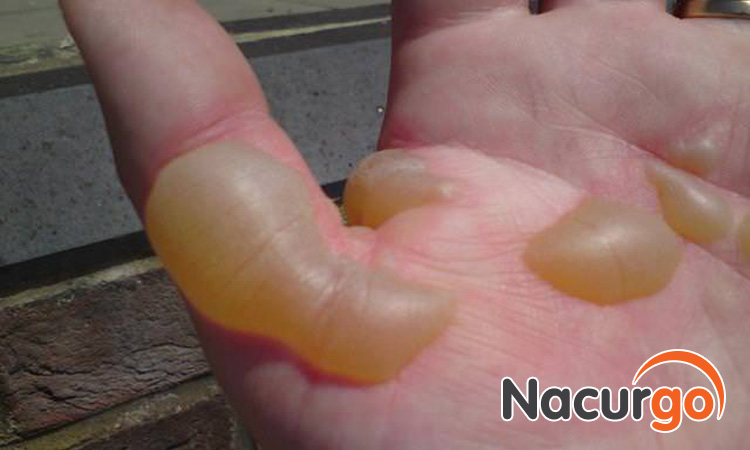Không nặn trích bọng nước do bỏng gây ra vì điều này rất nguy hiểm