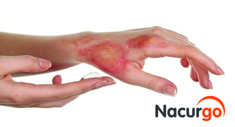 Nguyên nhân gây bỏng