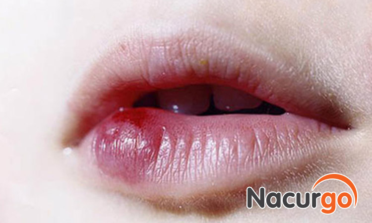 Bỏng môi để lại sẹo lồi rất mất thẩm mỹ