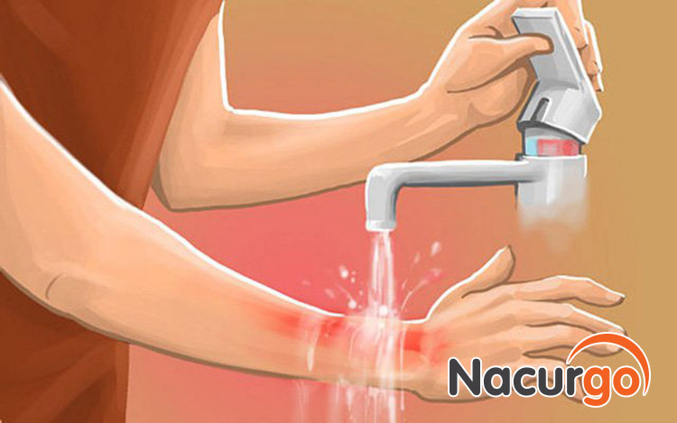 Bước đầu tiên: Làm mát vết bỏng