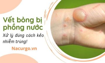 vet-bong-bi-phong-nuoc
