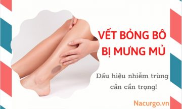 vet-bong-bo-bi-mung-mu