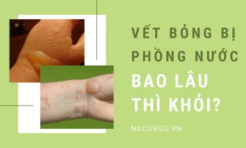 Vết bỏng bị phồng nước bao lâu thì khỏi