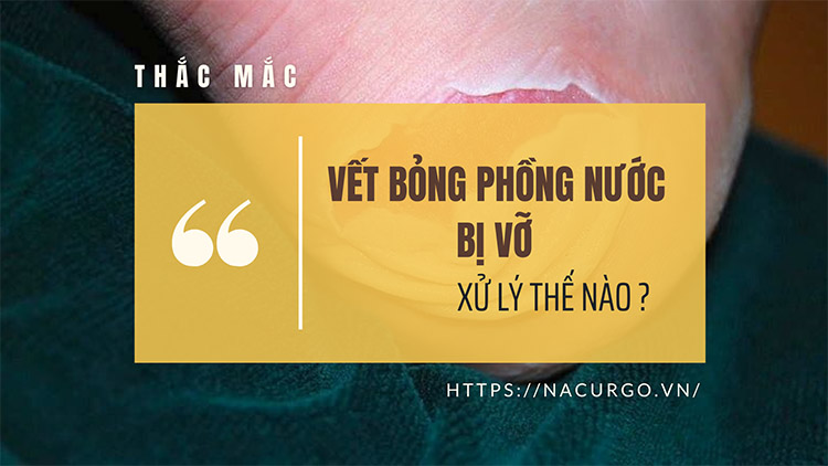 Vết bỏng phỏng nước bị vỡ