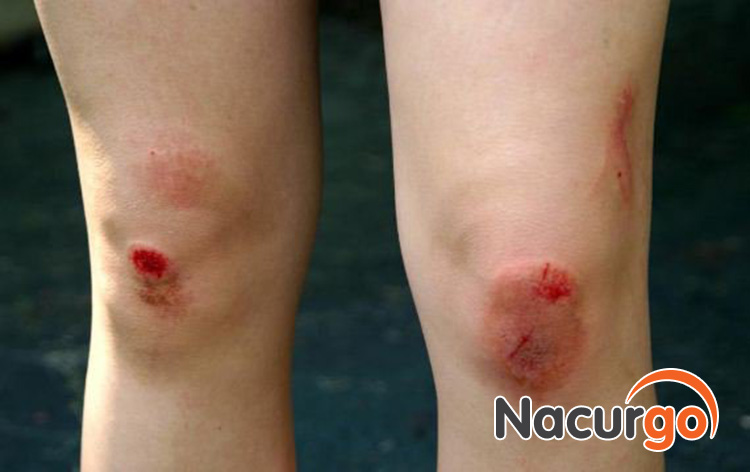 vết thương hở có nhu cầu về dinh dưỡng cao hơn bình thường