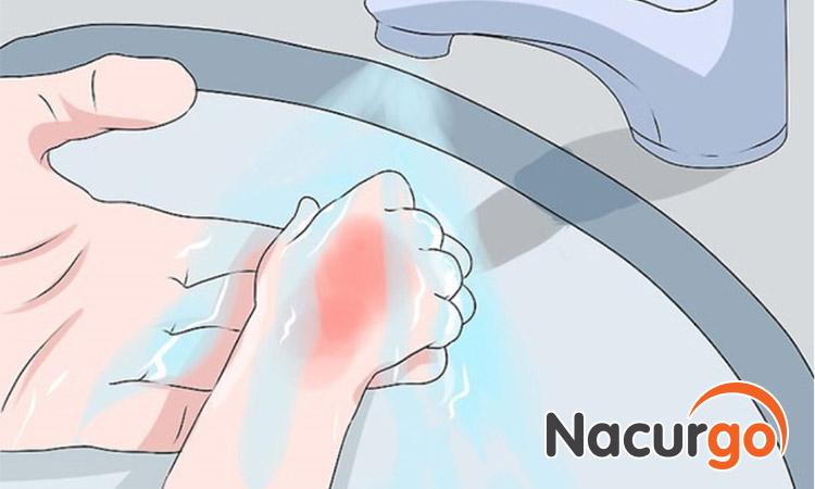 Ngâm vết bỏng vào nước sạch khoảng 15 đến 20 phút