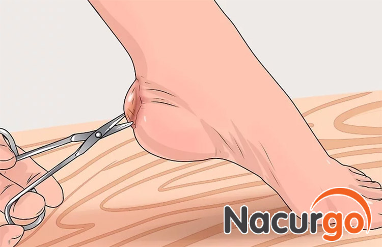 Cắt bỏ lớp da cũ khi lớp da mới đã hoàn thiện