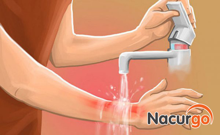 Bước đầu tiên: Làm mát và làm sạch vết bỏng bô