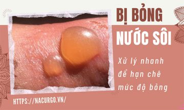 Bị bỏng nước sôi xử lý như thế nào?