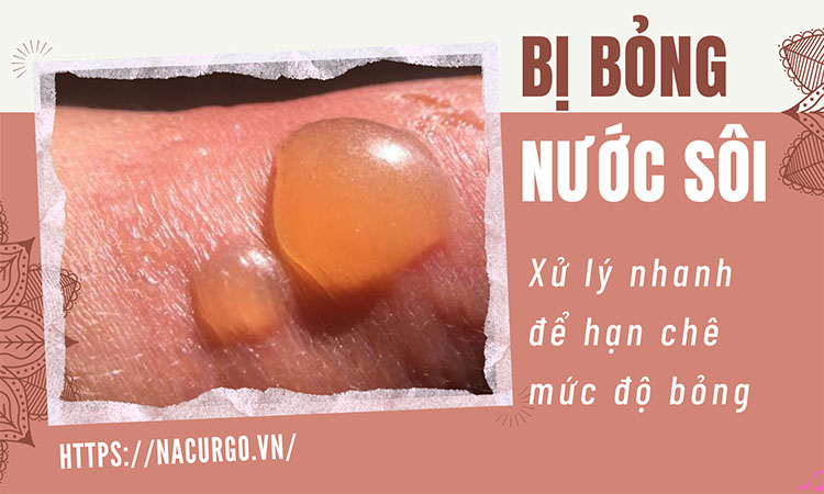Bị bỏng nước sôi xử lý như thế nào?