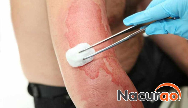 Điều trị y tế nếu vết bỏng ở mức độ nặng nề