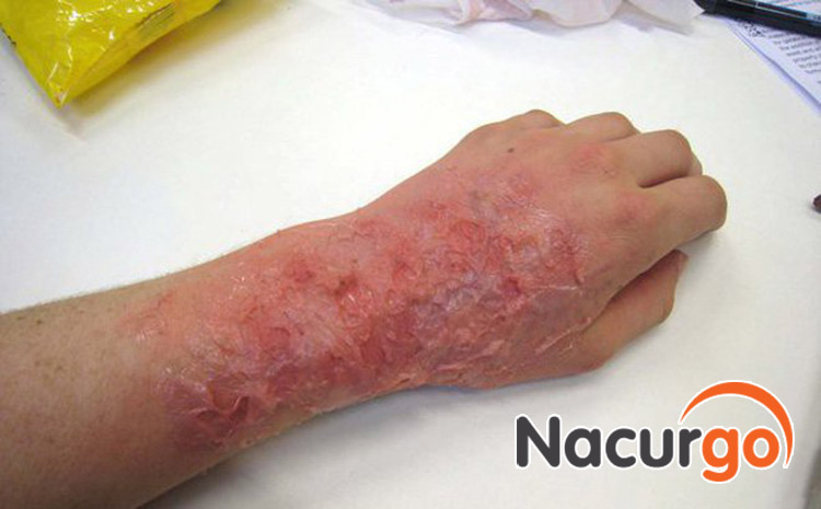 Vết bỏng phồng rộp bị vỡ hoàn toàn có thể bị nhiễm trùng nếu không được chăm sóc đúng cách