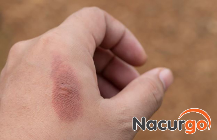 Vết bỏng nhẹ, tổn thương nông bạn có thể điều trị hiệu quả bằng nha đam