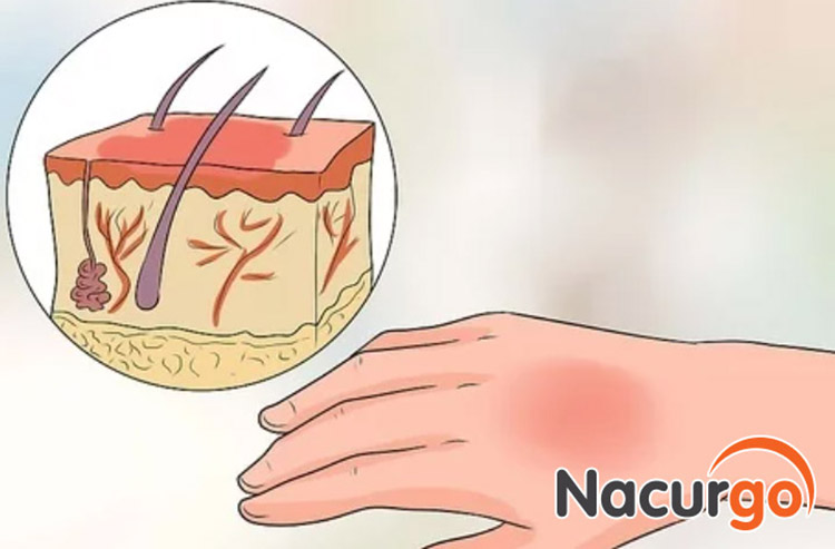 Hình ảnh mô phỏng bỏng nước sôi cấp 1