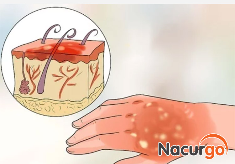 Hình ảnh mô phỏng bỏng nước sôi cấp 2