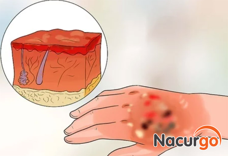 Hình ảnh mô phỏng bỏng nước sôi cấp 3