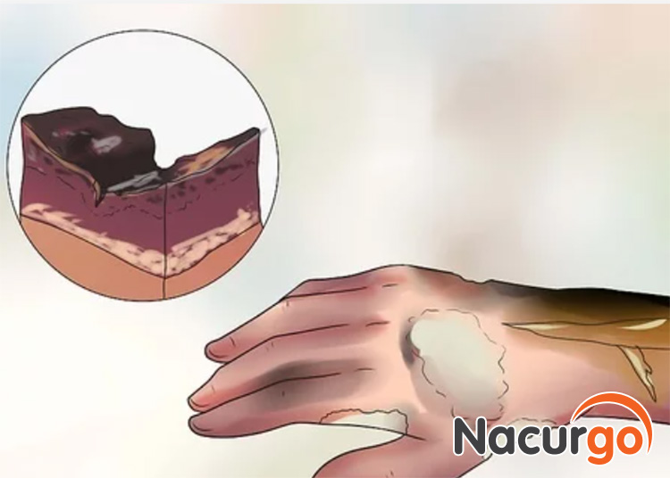 Hình ảnh mô phỏng bỏng nước sôi cấp 4