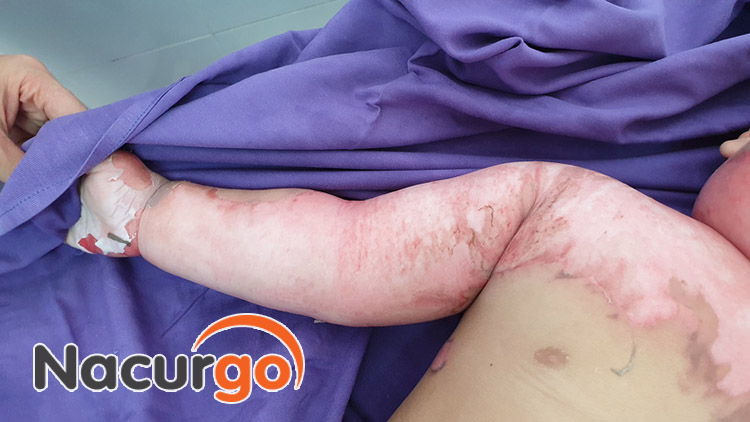 Trị bỏng nước sôi ở trẻ