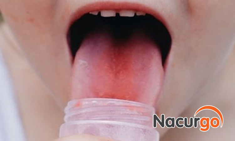 Bỏng lưỡi nếu không chăm sóc đúng cách có thể gây nhiễm trùng hoại tử lưỡi