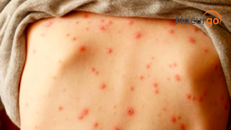 nhiem-trung-da-do-virus